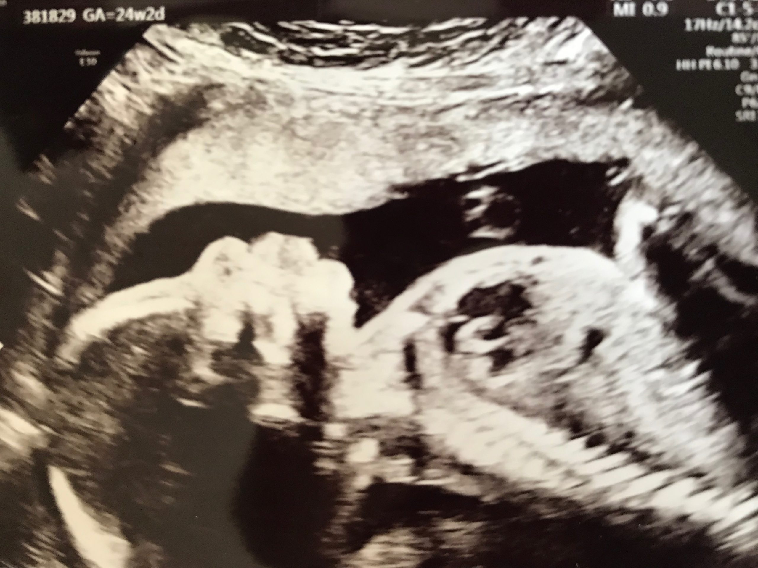 Anatomy Scan And 4d Ultrasound In Japan